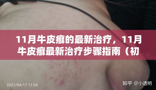 11月牛皮癣最新治疗指南，初学者与进阶用户适用的步骤和策略